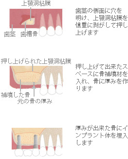 サイナスリフト法