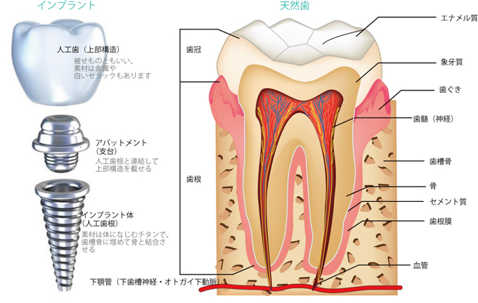 第3の歯インプラント