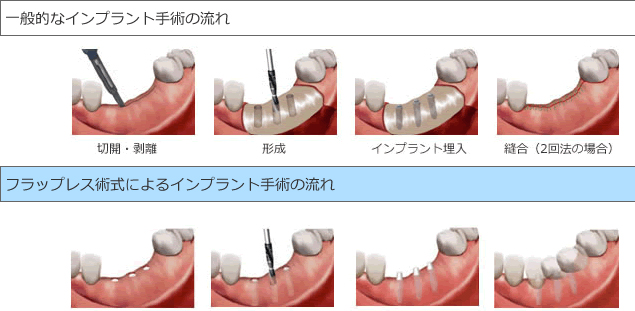 無切開無痛手術（フラップレス）