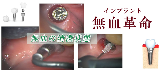 大阪高槻市にある歯医者インプラント専門医の赤木歯科のインプラント無血革命