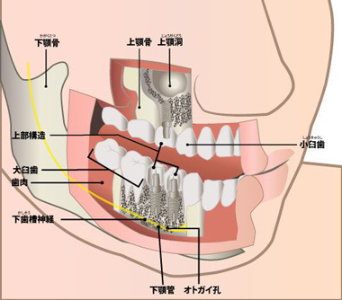 インプラント治療